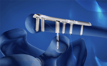 The Suspension Distal Clavicle Fracture Fixation System (Photo courtesy of Suspension Orthopaedic Solutions). The Suspension Distal Clavicle Fracture Fixation System (Photo courtesy of Suspension Orthopaedic Solutions).